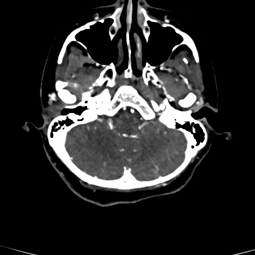 Cerebral arteriovenous malformation (Radiopaedia 73830-84645 Axial C+ delayed 77).jpg