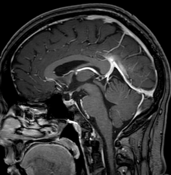 Cerebral arteriovenous malformation (Radiopaedia 74411-85746 Sagittal T1 C+ 64).jpg