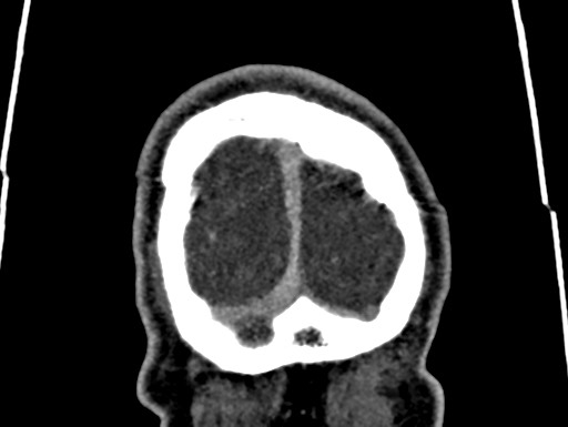 Cerebral arteriovenous malformation (Radiopaedia 78188-90746 Coronal C+ delayed 122).jpg