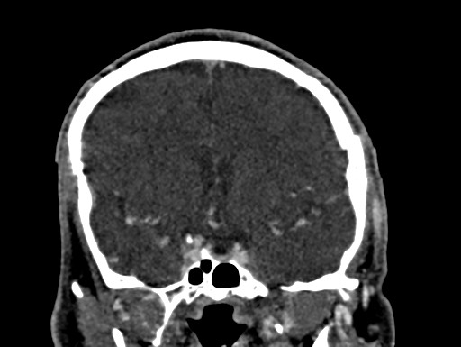 File:Cerebral arteriovenous malformation (Radiopaedia 78188-90746 Coronal C+ delayed 45).jpg