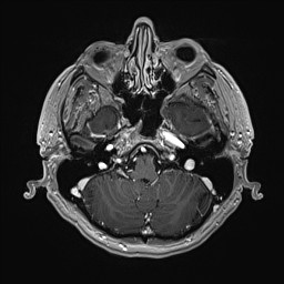 Cerebral arteriovenous malformation (Radiopaedia 84015-99245 Axial T1 C+ 39).jpg
