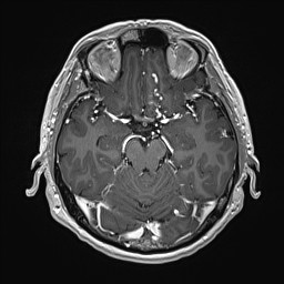 File:Cerebral arteriovenous malformation (Radiopaedia 84015-99245 Axial T1 C+ 63).jpg