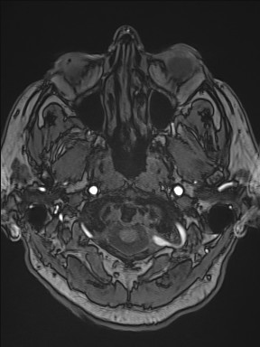 Cerebral arteriovenous malformation (Radiopaedia 84015-99245 Axial TOF 42).jpg