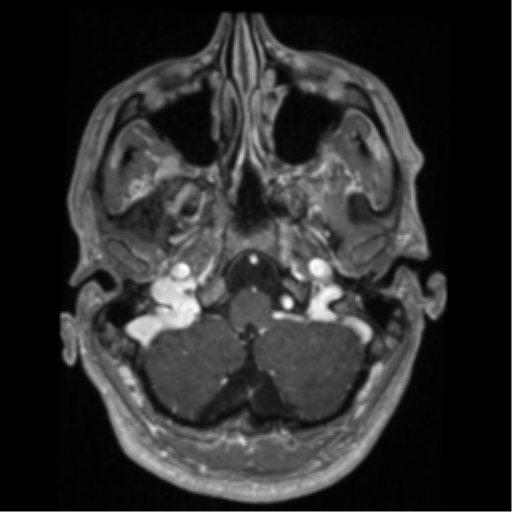 Cerebral arteriovenous malformation - huge (Radiopaedia 35734-37272 Axial T1 C+ 10).png
