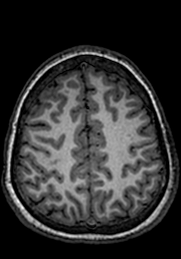 Cerebral arteriovenous malformation at posterior body of corpus callosum (Radiopaedia 74111-84925 Axial T1 62).jpg