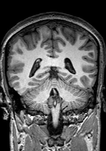 Cerebral arteriovenous malformation at posterior body of corpus callosum (Radiopaedia 74111-84925 Coronal T1 230).jpg