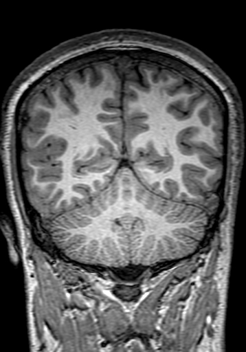 Cerebral arteriovenous malformation at posterior body of corpus callosum (Radiopaedia 74111-84925 Coronal T1 253).jpg
