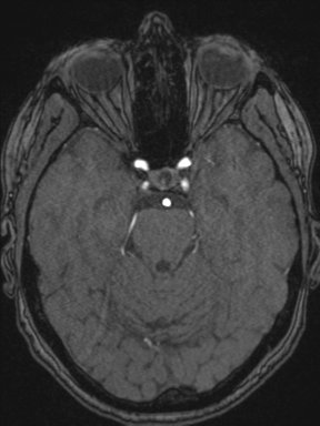 Cerebral arteriovenous malformation with hemorrhage (Radiopaedia 34422-35737 Axial MRA 28).png