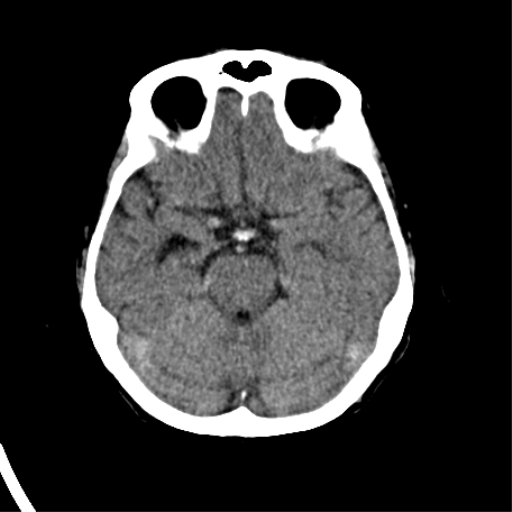 File:Cerebral arteriovenous malformation with lobar hemorrhage (Radiopaedia 44725-48510 Axial non-contrast 17).png