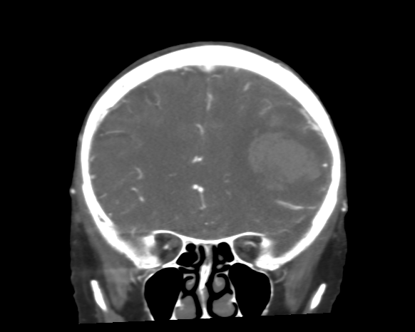 Cerebral arteriovenous malformation with lobar hemorrhage (Radiopaedia 44725-48511 A 19).png