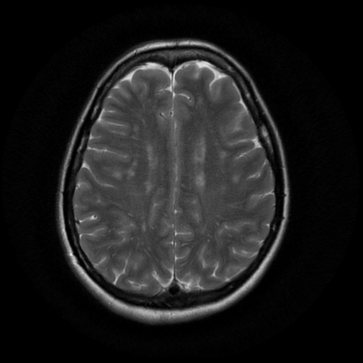File:Cerebral autosomal dominant arteriopathy with subcortical infarcts and leukoencephalopathy (CADASIL) (Radiopaedia 41018-43763 Ax T2 PROP 14).png