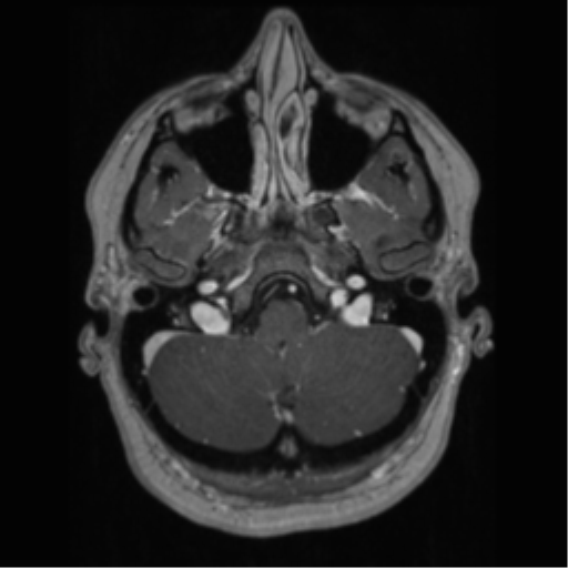 Cerebral cavernoma and development venous anomaly (Radiopaedia 37603-39482 Axial T1 C+ 15).png