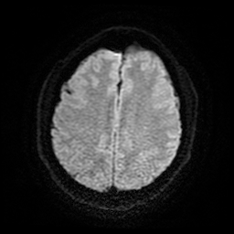 Cerebral cavernous venous malformation (Zabramski type II) (Radiopaedia 85511-101198 Axial DWI 22).jpg