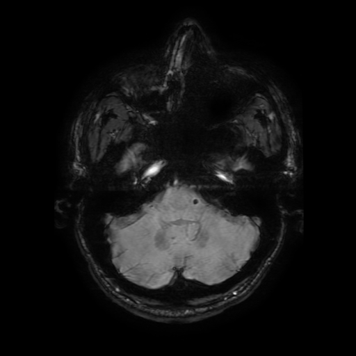 Cerebral cavernous venous malformation (Zabramski type II) (Radiopaedia 85511-101198 Axial SWI 31).jpg