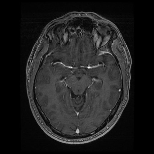 Cerebral cavernous venous malformation (Zabramski type II) (Radiopaedia 85511-101198 Axial T1 C+ fat sat 51).jpg