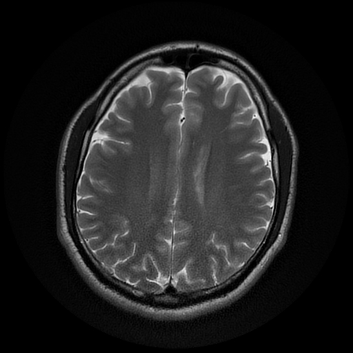 File:Cerebral cavernous venous malformation (Zabramski type II) (Radiopaedia 85511-101198 Axial T2 21).jpg