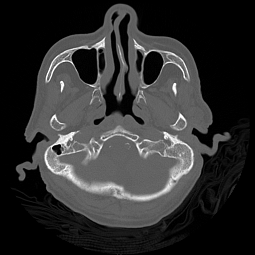 Cerebral contusions, subarachnoid hemorrhage and subdural hygromas (Radiopaedia 55399-61827 Axial bone window 8).png