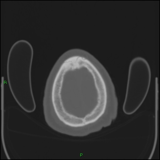Cerebral contusions (Radiopaedia 33868-35039 Axial bone window 207).jpg