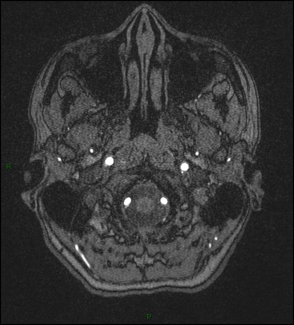 Cerebral fat embolism (Radiopaedia 35022-36525 Axial TOF 4).jpg