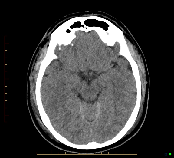 File:Cerebral fat embolism (Radiopaedia 85521-101224 Axial non-contrast 21).jpg