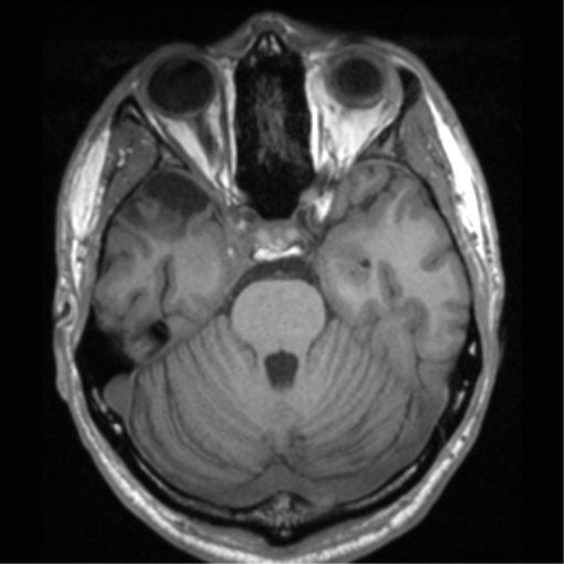 Cerebral hemorrhagic contusions- temporal evolution (Radiopaedia 40224-42757 Axial T1 25).png