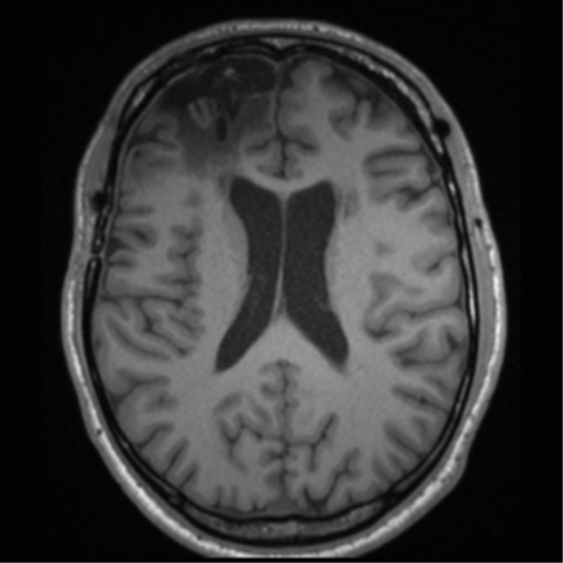 Cerebral hemorrhagic contusions- temporal evolution (Radiopaedia 40224-42757 Axial T1 46).png