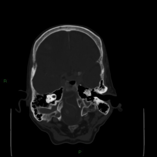 Cerebral metastases - breast primary (Radiopaedia 77653-89857 Axial bone window 31).jpg
