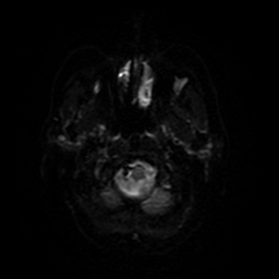 File:Cerebral metastases - melanoma (Radiopaedia 80972-94522 Axial DWI 68).jpg
