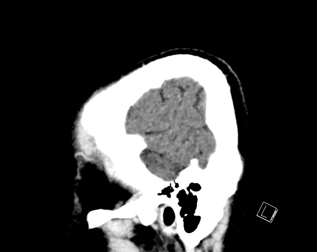 Cerebral metastases - testicular choriocarcinoma (Radiopaedia 84486-99855 F 50).jpg