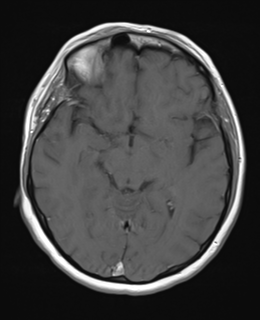File:Cerebral metastases mimicking abscesses (Radiopaedia 45841-50131 Axial T1 C+ fat sat 13).png