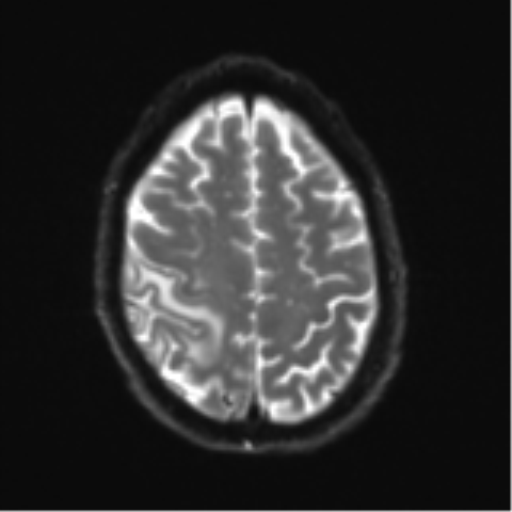Cerebral metastasis - melanoma (Radiopaedia 54718-60954 Axial DWI 24).png