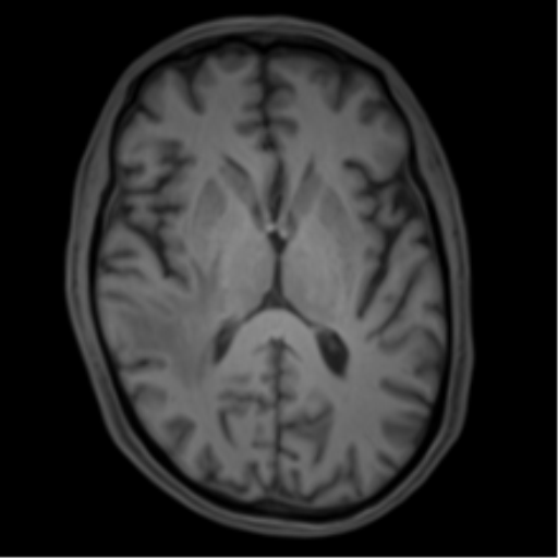 Cerebral metastasis - melanoma (Radiopaedia 54718-60954 Axial T1 28).png