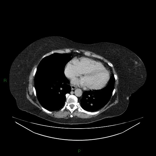File:Cerebral metastasis from renal cell carcinoma (Radiopaedia 82306-96378 A 4).jpg
