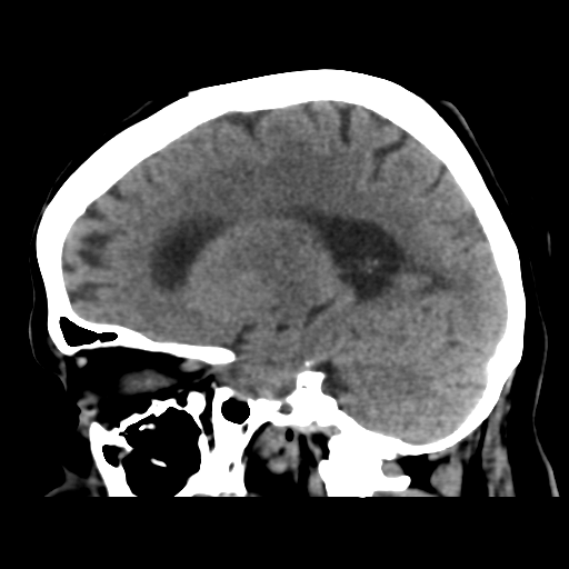File:Cerebral metastasis to basal ganglia (Radiopaedia 81568-95412 E 39).png