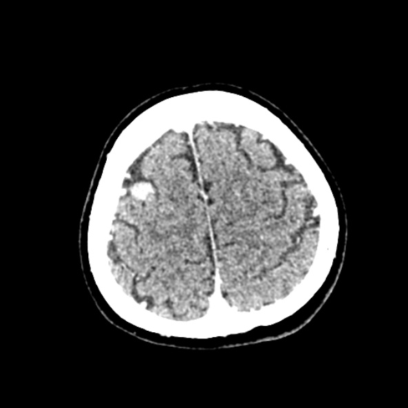 Cerebral ring enhancing lesions - cerebral metastases (Radiopaedia 44922-48818 B 239).jpg
