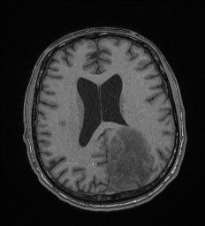 Cerebral toxoplasmosis (Radiopaedia 43956-47461 Axial T1 49).jpg