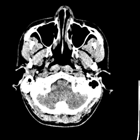 Cerebral toxoplasmosis (Radiopaedia 53993-60131 Axial non-contrast 11).jpg