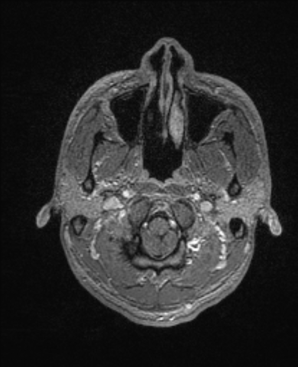 Cerebral toxoplasmosis (Radiopaedia 85779-101597 Axial T1 C+ 15).jpg