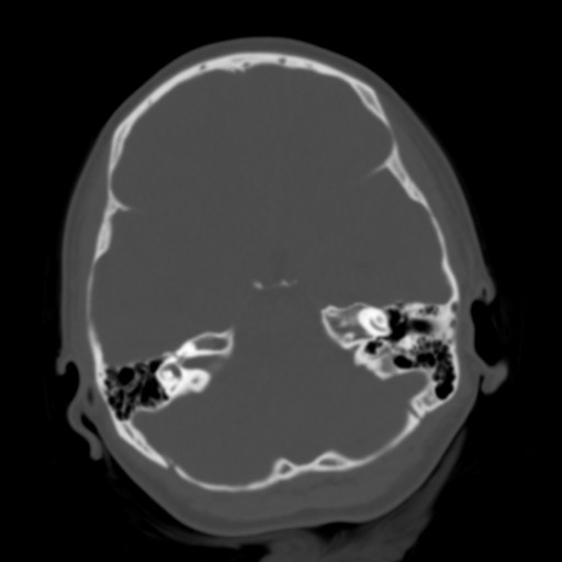 Cerebral tuberculosis with dural sinus invasion (Radiopaedia 60353-68018 Axial bone window 14).jpg