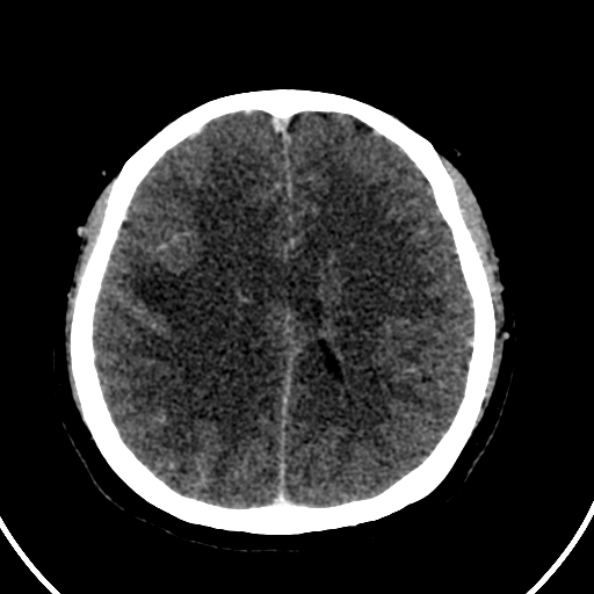 Cerebral venous hemorrhagic infarct from venous sinus thrombosis (Radiopaedia 55433-61883 Axial C+ delayed 59).jpg