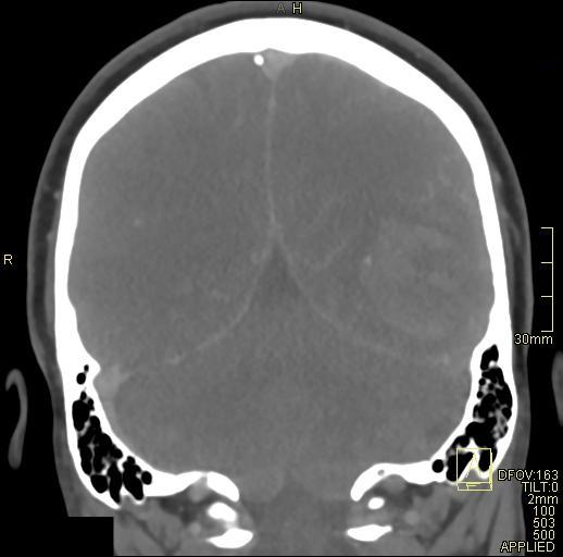 Cerebral venous sinus thrombosis (Radiopaedia 91329-108965 Coronal venogram 63).jpg