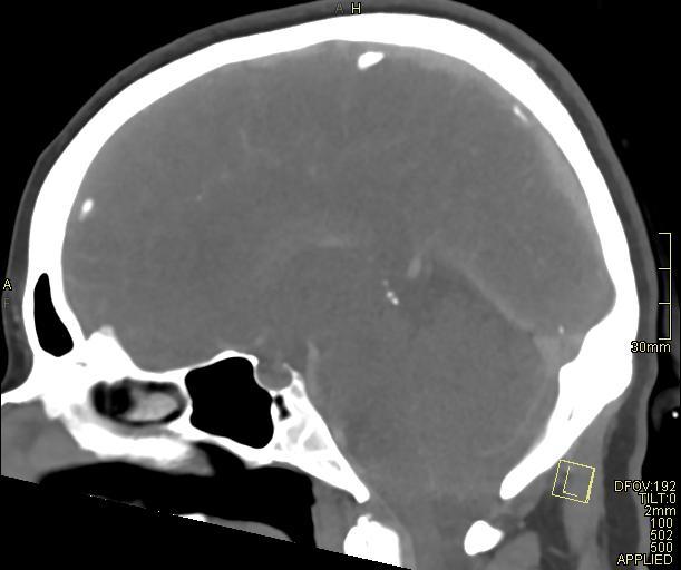Cerebral venous sinus thrombosis (Radiopaedia 91329-108965 Sagittal venogram 39).jpg