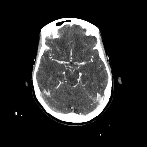 File:Cerebral venous throbmosis - hemorrhagic venous infarction (Radiopaedia 87318-103613 Axial CT venogram 10).jpg