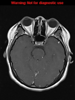 File:Cerebral venous thrombosis (Radiopaedia 37224-39208 Axial T1 C+ 8).jpg