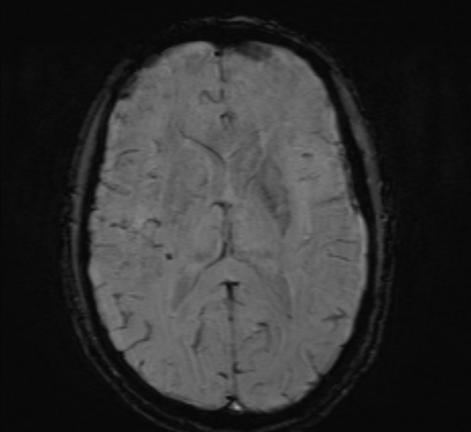 Cerebral venous thrombosis (Radiopaedia 71207-81504 Axial SWI 29).jpg