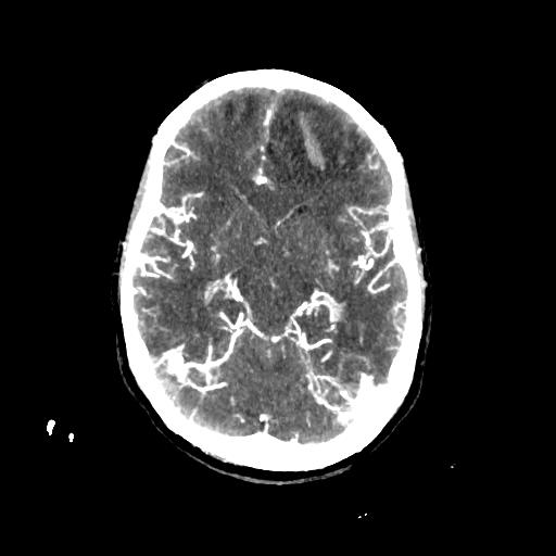 File:Cerebral venous thrombosis - hemorrhagic venous infarction (Radiopaedia 87318-103613 Axial 185).jpg