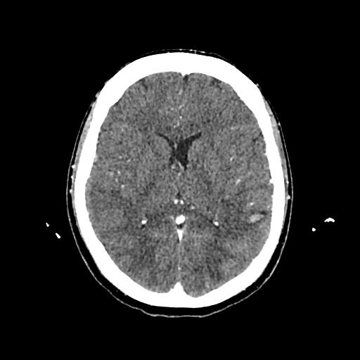 File:Cerebral venous thrombosis with venous hemorrhagic infarct (Radiopaedia 90354-107660 Axial with contrast 91).jpg