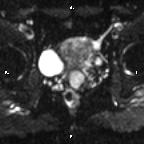 Cervical adenocarcinoma (Radiopaedia 65011-73985 Axial DWI 40).jpg