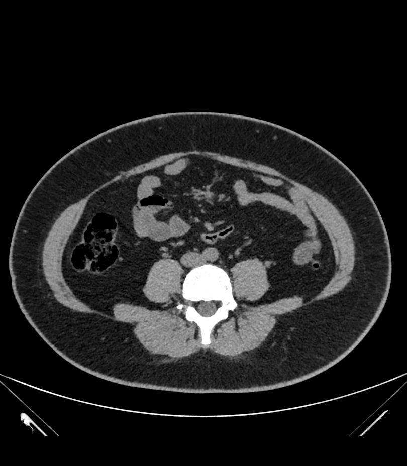 Cervical aortic arch with coarctation and aneurysms (Radiopaedia 44035-47552 Axial non-contrast 69).jpg