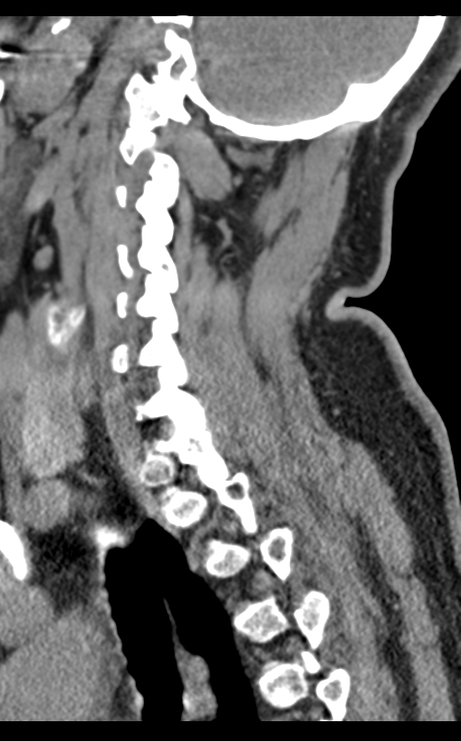 Cervical canal stenosis due to ossification of the posterior longitudinal ligament (Radiopaedia 47260-51823 D 54).png